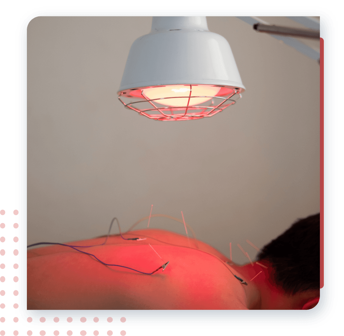 ฝังเข็ม กระตุ้นไฟฟ้า ฉายแสงอินฟาเรด